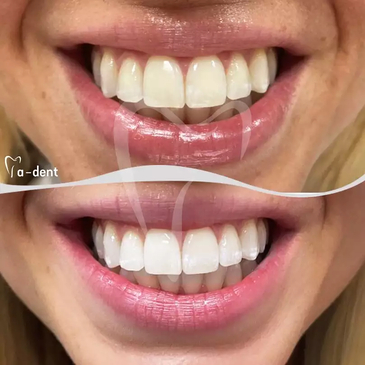 Slider image (4) A-Dent Dental Clinic in Antalya, Turkey